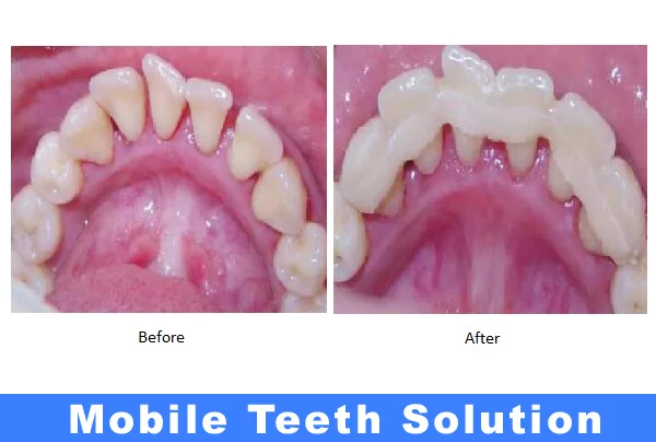 Mobile Teeth Treatment